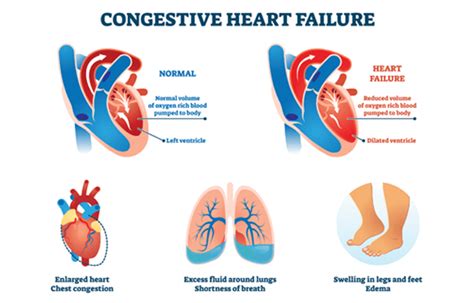 ccf stands for medical|CHF: Medical Abbreviation for Congestive Heart Failure .
